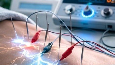 Eletroacupuntura com dispositivo e estímulos controlados